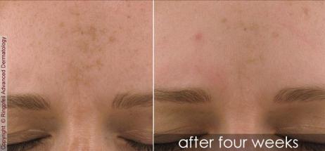 Melasma- before and after treatment, female forehead