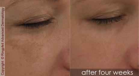 Melasma- before and after treatment, female face under eye