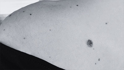 Mole Removal