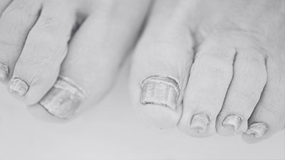 Nail Fungus