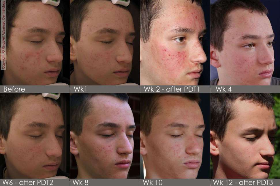 mild acne vulgaris