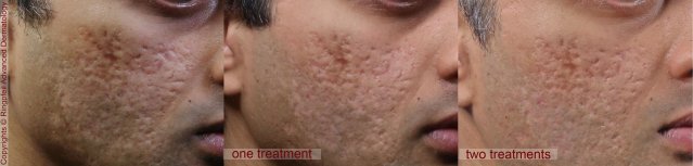 Before and After INFINI RF MICRONEEDLING Treatment, NYC in Ringpfeil Advanced Dermatology - male face