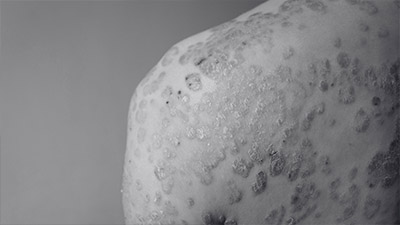 Psoriasis Treatment