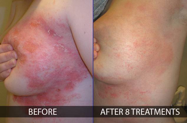 Psoriasis before and after treatments, female breasts, patient 1