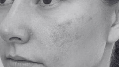Rosacea
