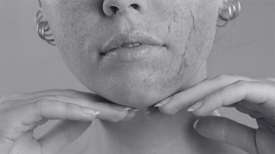 Rosacea Treatment