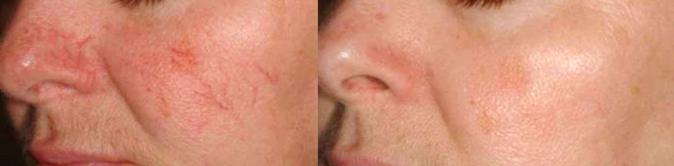 Rosacea - before and after treatment, female patient, face, cheek