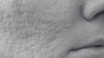 Scars Treatment