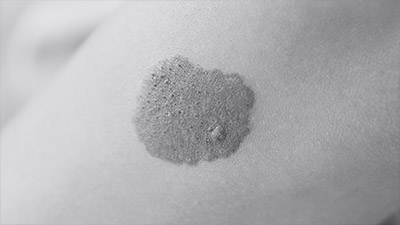 Skin Cancer