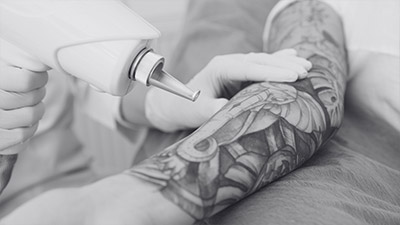 Tattoo Removal