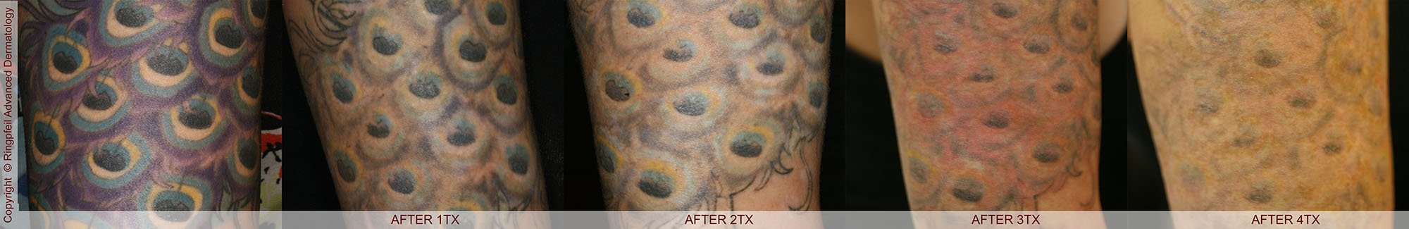 Before and After 4 Treatment -Picosure Vs. QSwitch in Philadelphia - tattoo removal, patient hand