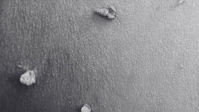 Warts Treatment