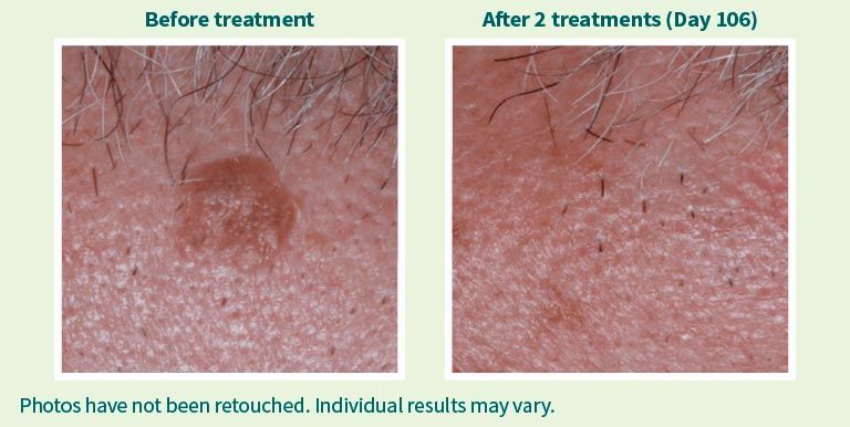 Eskata. Before and After 2 treatments (day 106)