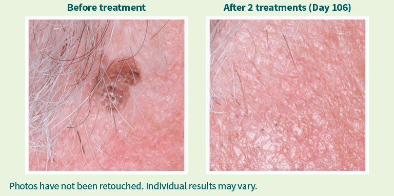 Eskata. Before and After 2 treatments (day 106), patient 2