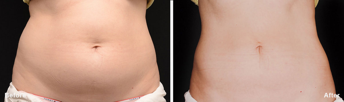 Coolsculpting - Before and After Treatment photos,  tummy tuck - female patint 3