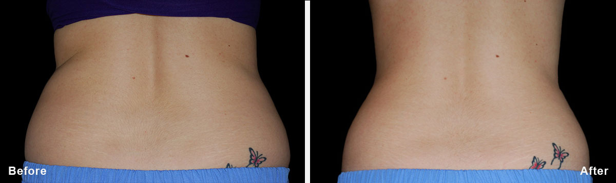 Coolsculpting - Before and After Treatment photos, back - female patint 7