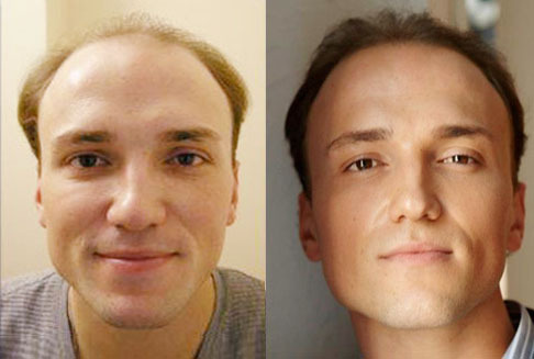 Before/After Hair Restoration