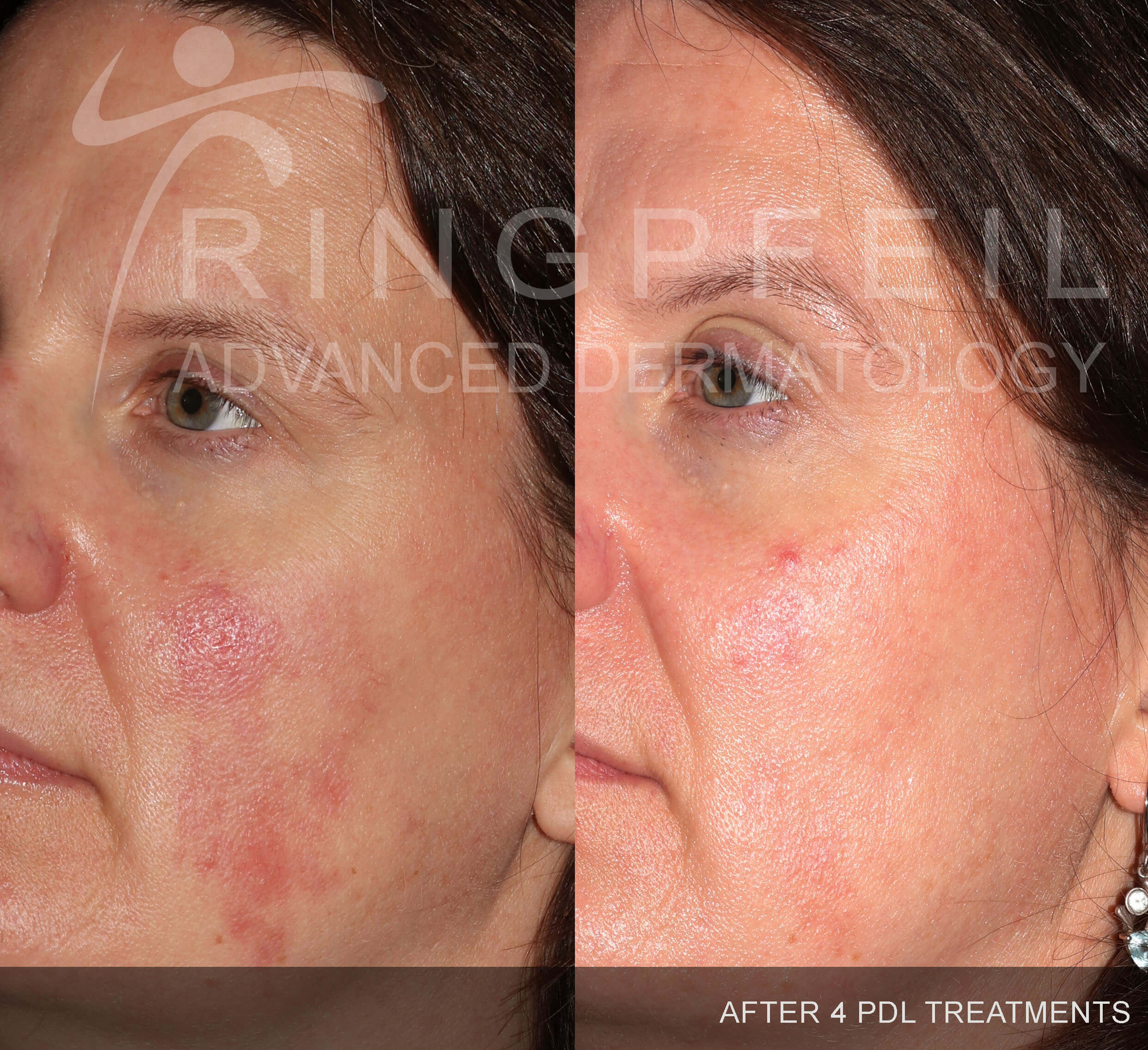Rosacea - before and after 4 PDL 