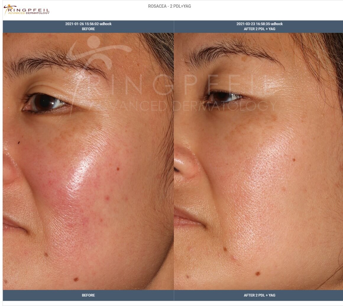Rosacea - before and after 2 PDL YAG