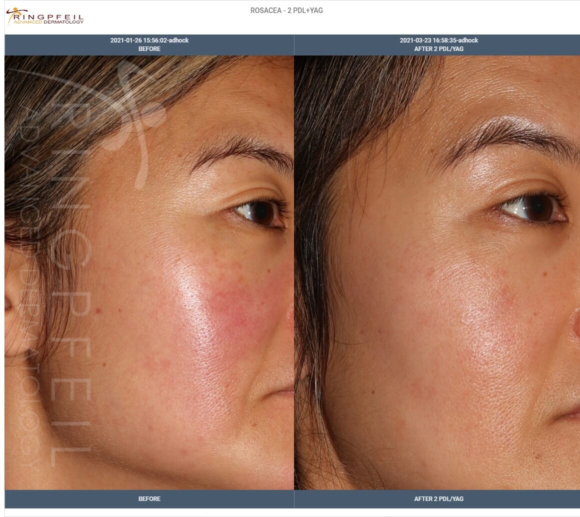 Rosacea - before and after 2 PDL YAG 