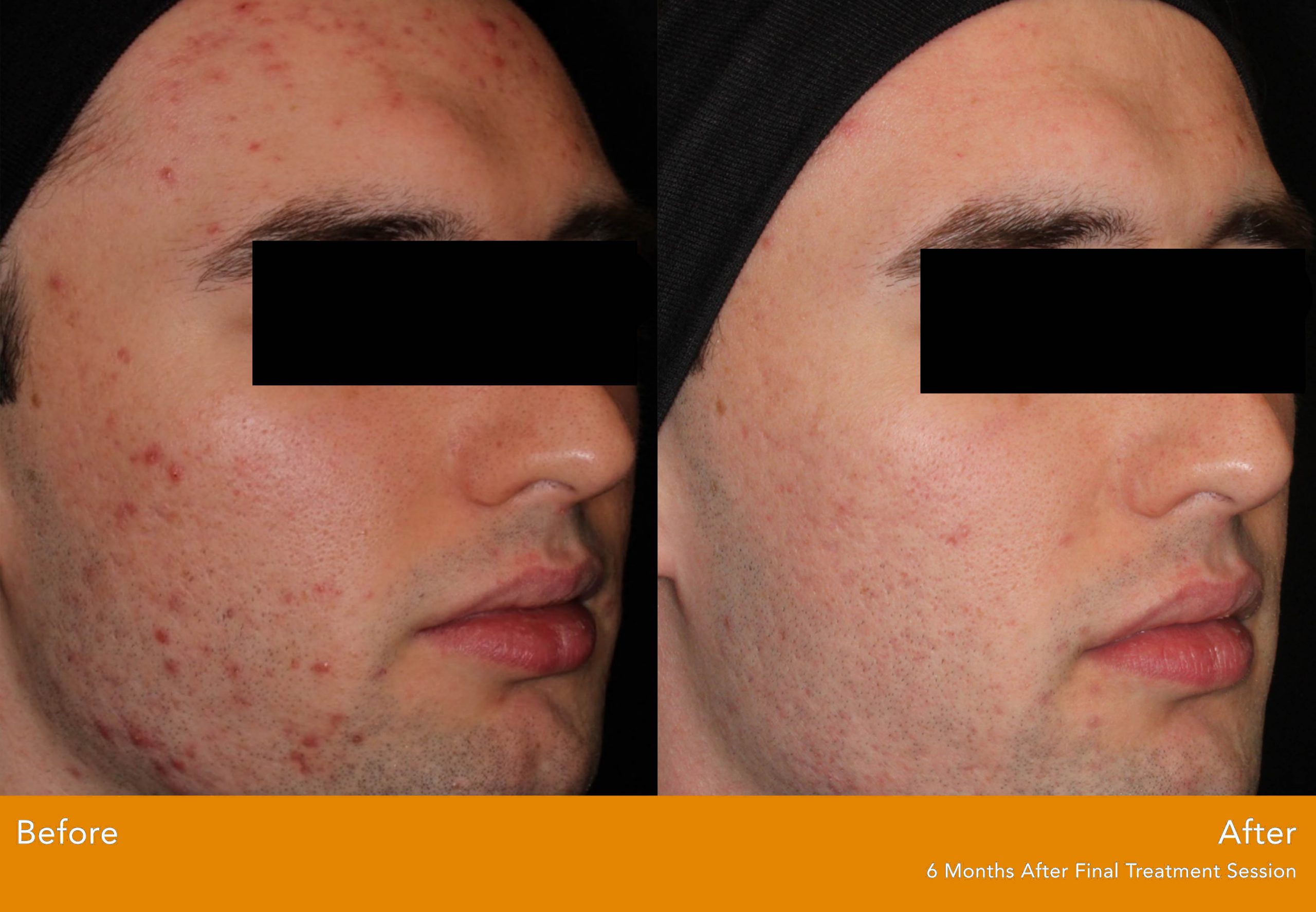 AviClear ACNE Laser | Performed At A Dermatology Practice