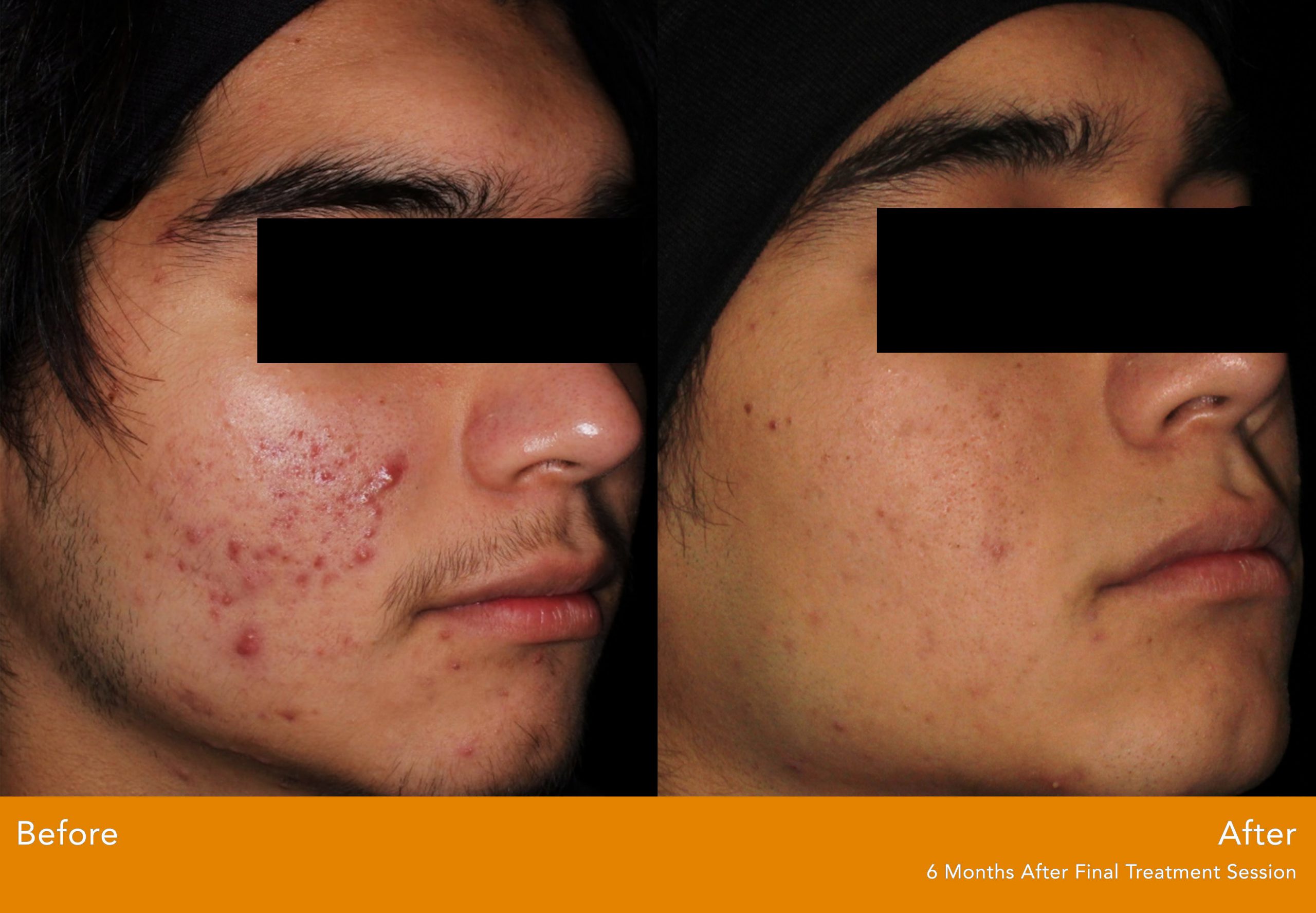 AviClear ACNE | Performed At A Dermatology Practice