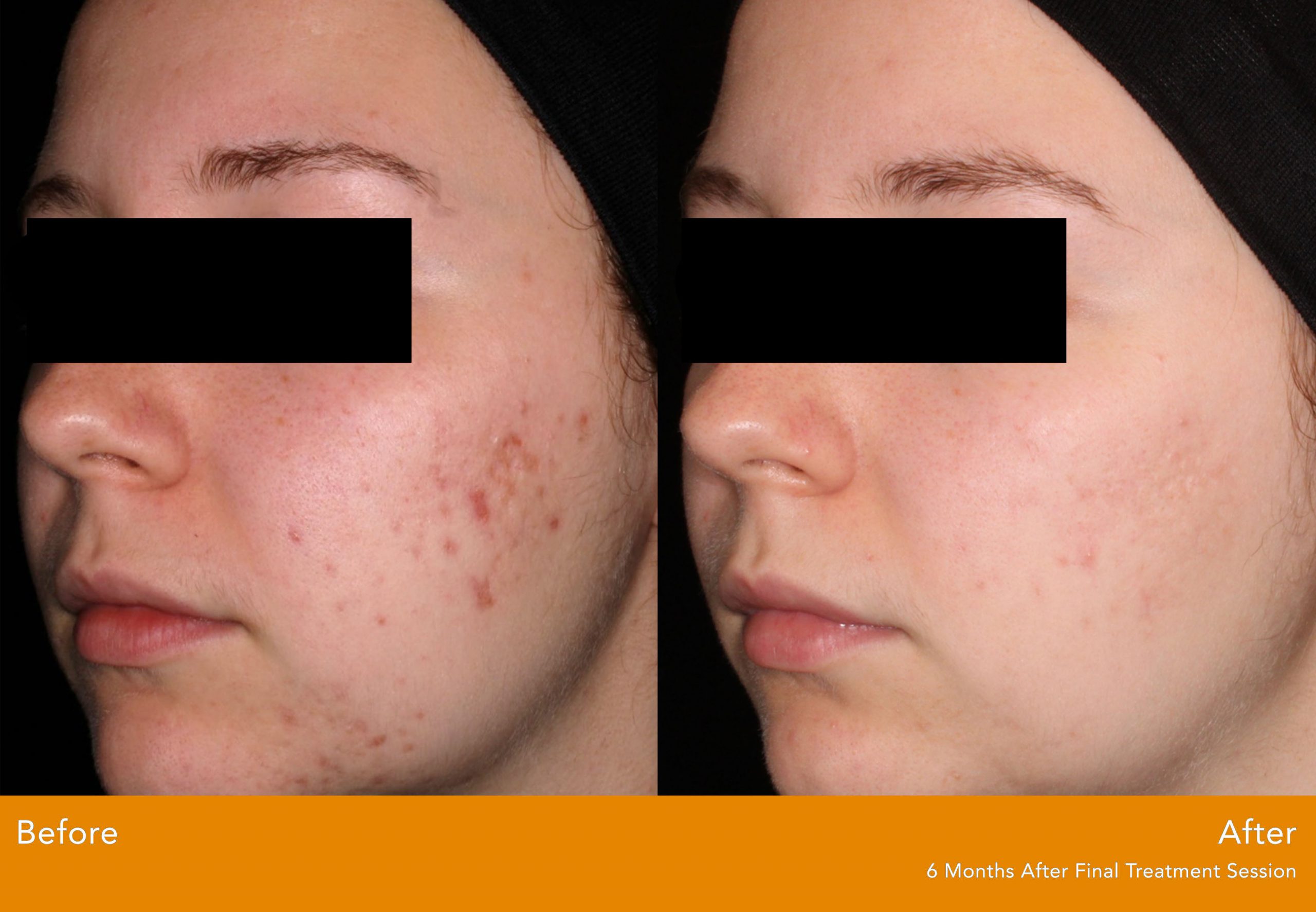 AviClear ACNE | Performed At A Dermatology Practice