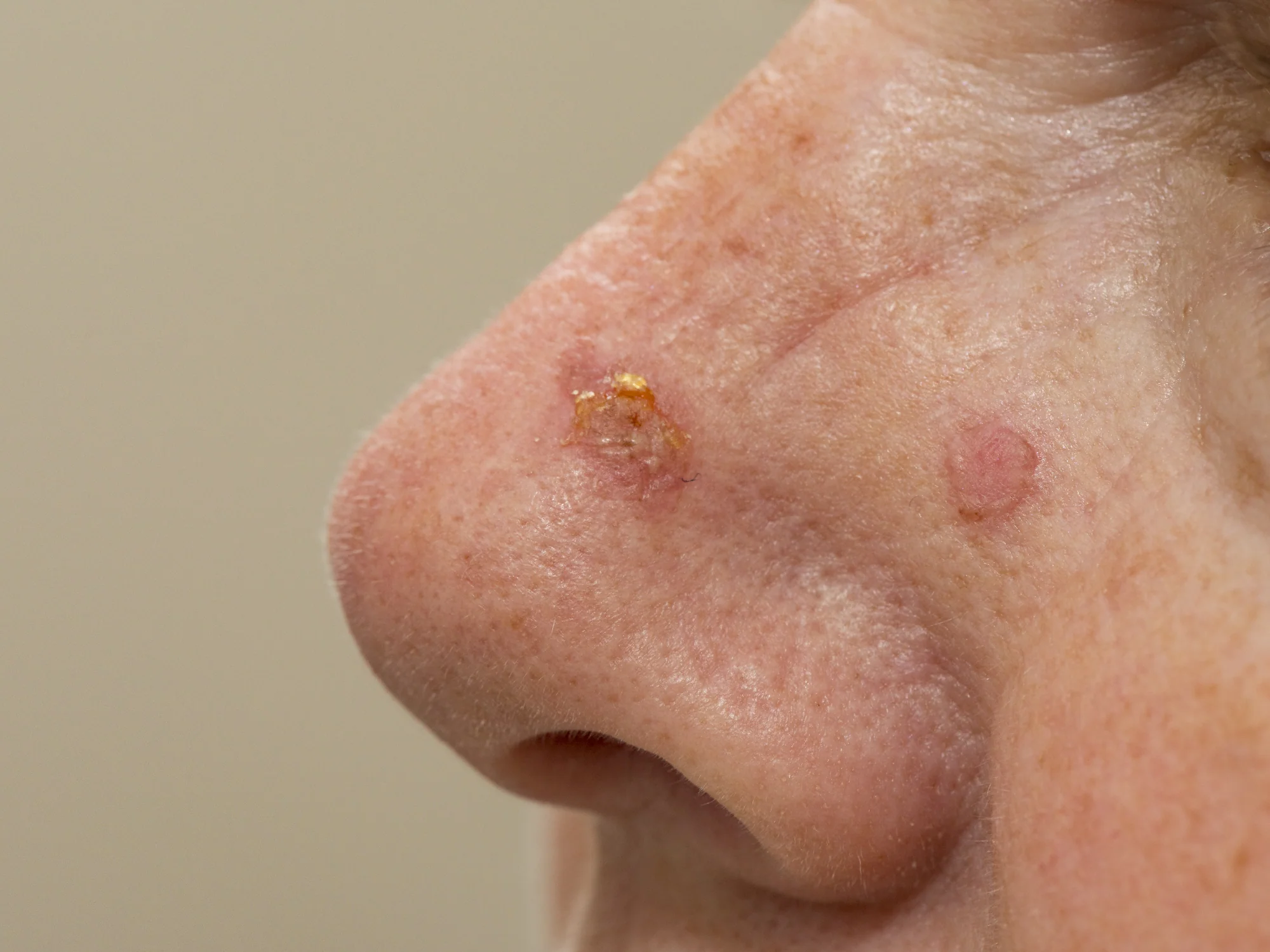 Actinic Keratosis