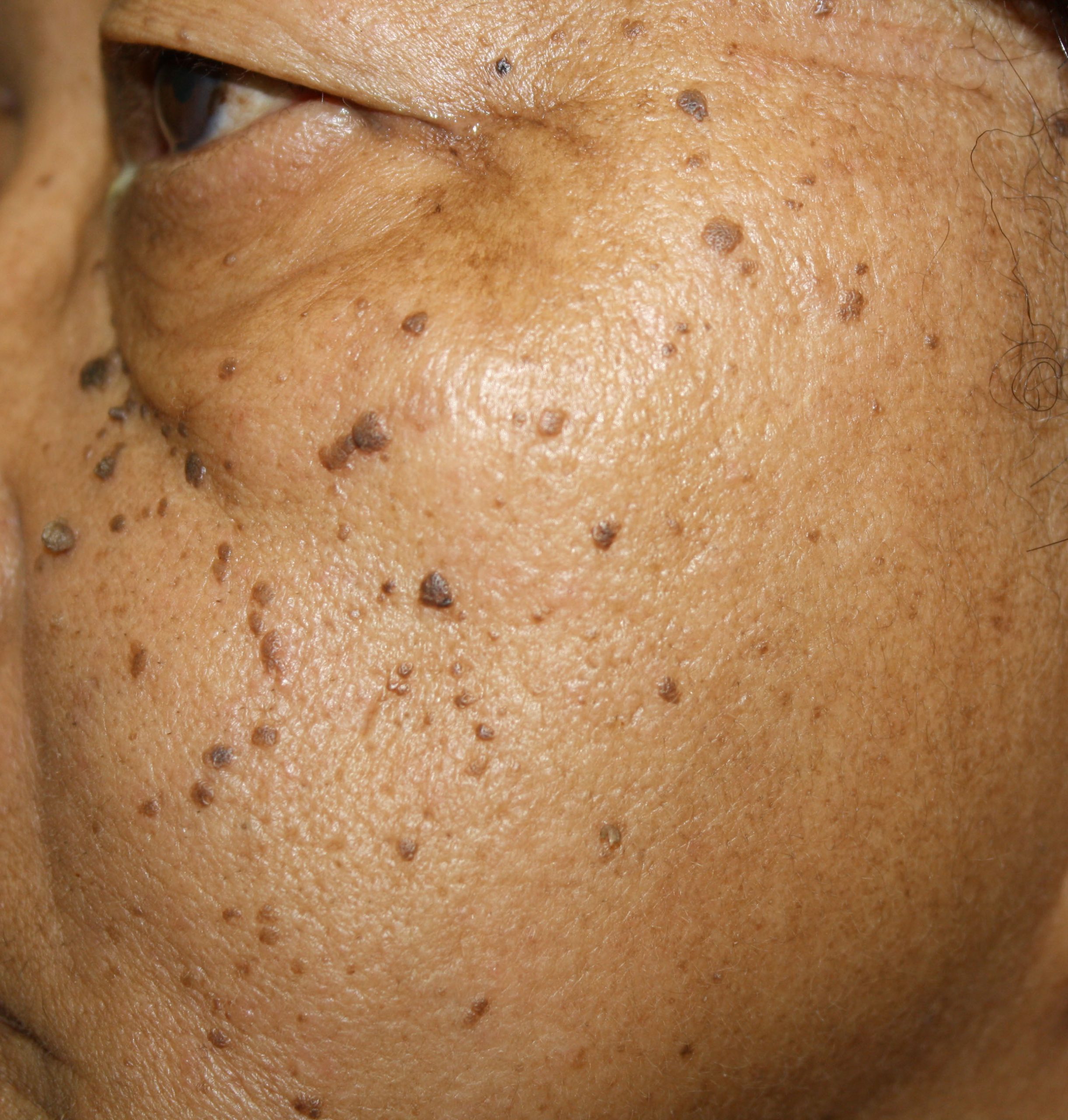 DERMATOSIS PAPULOSA NIGRA