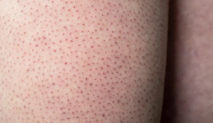 keratosis-pilaris-dermatologist-philadelphia-dermatology-practice