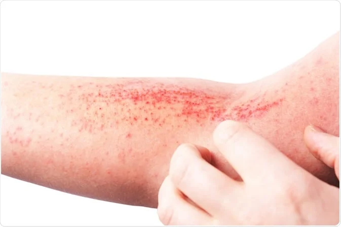 Eczema