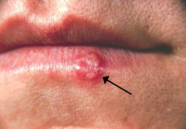 Herpes Simplex