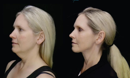 Before and After Restylane Treatment, female face (front view)