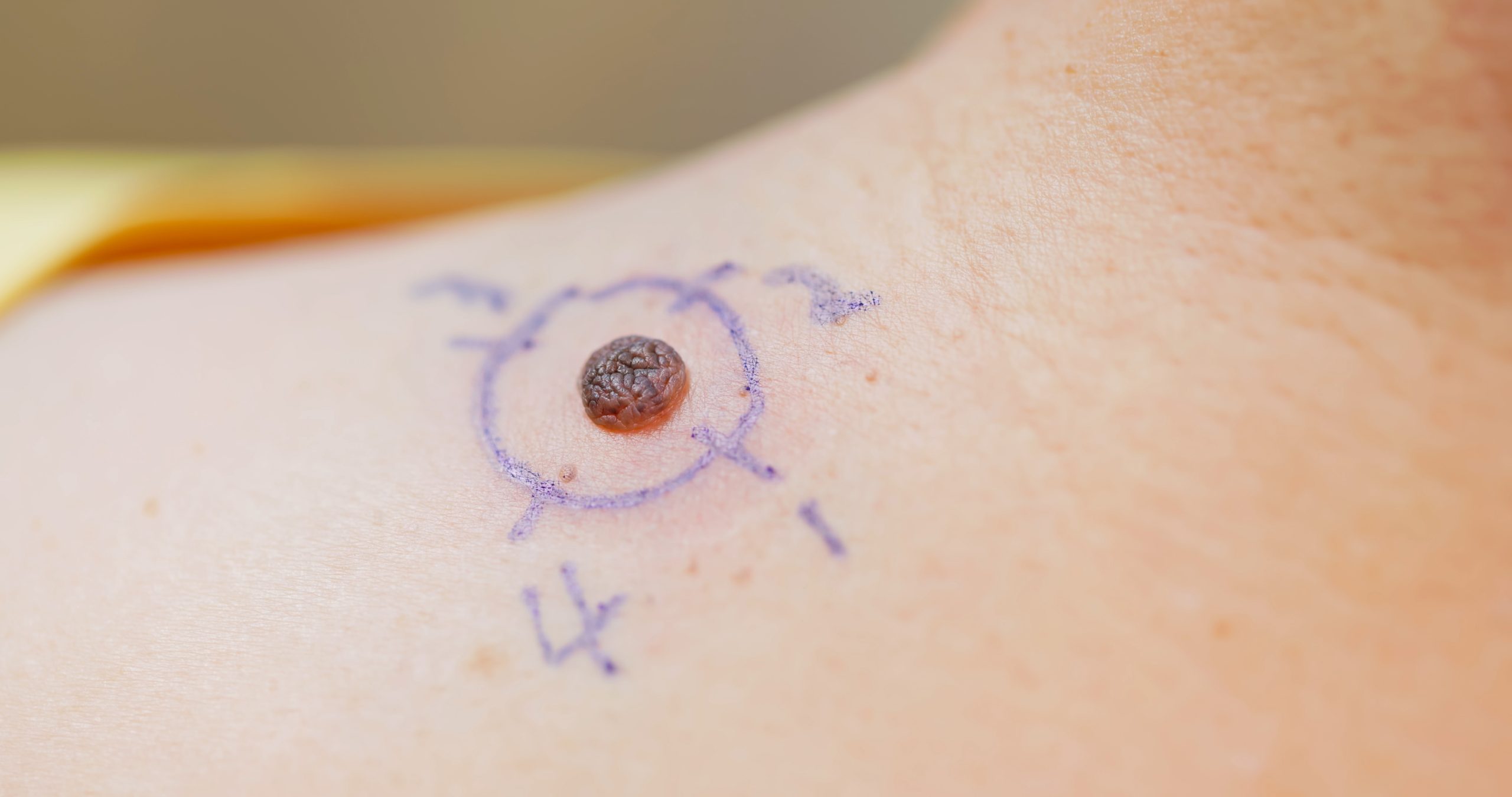 mole treatment marking