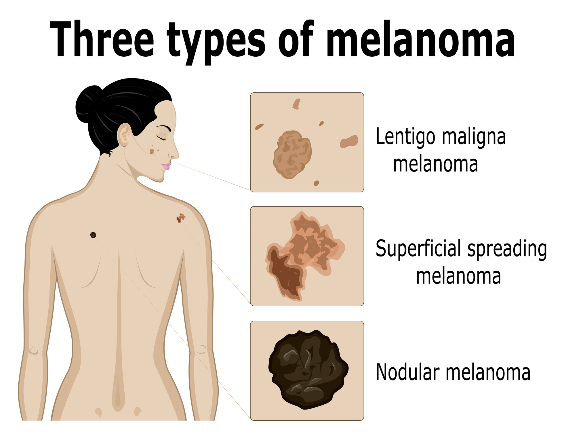 Types of Skin Cancer
